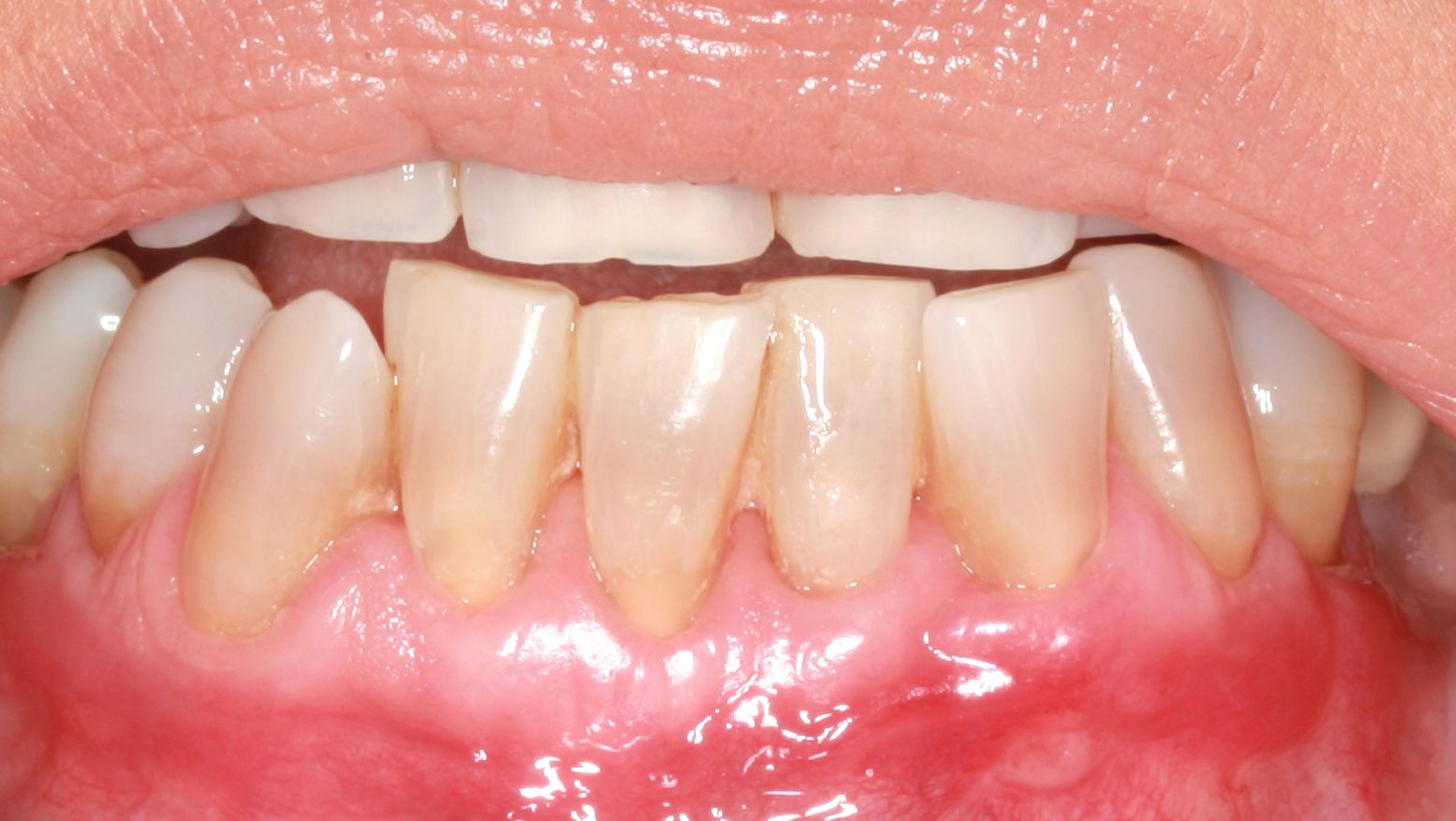 After treatment of receding gums using the Pinhole technique