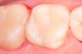 Amalgam removal treatment, old metal fillings in Padrós dental clinic. Your dentist in Barcelona