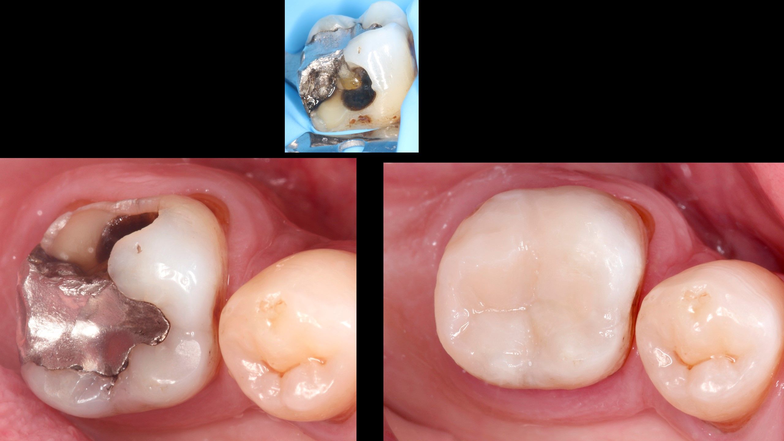 Amalgam removal treatment, old metal fillings in Padrós dental clinic. Your dentist in Barcelona