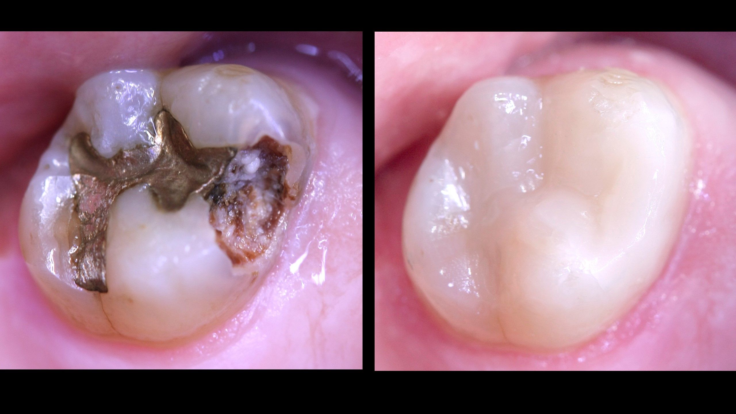 Amalgam removal treatment, old metal fillings in Padrós dental clinic. Your dentist in Barcelona