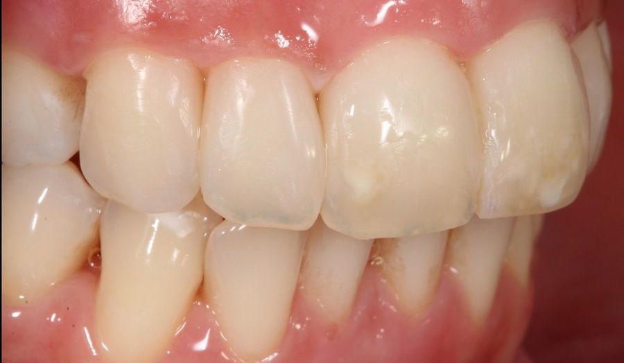 Treatment problem of black triangles between the teeth