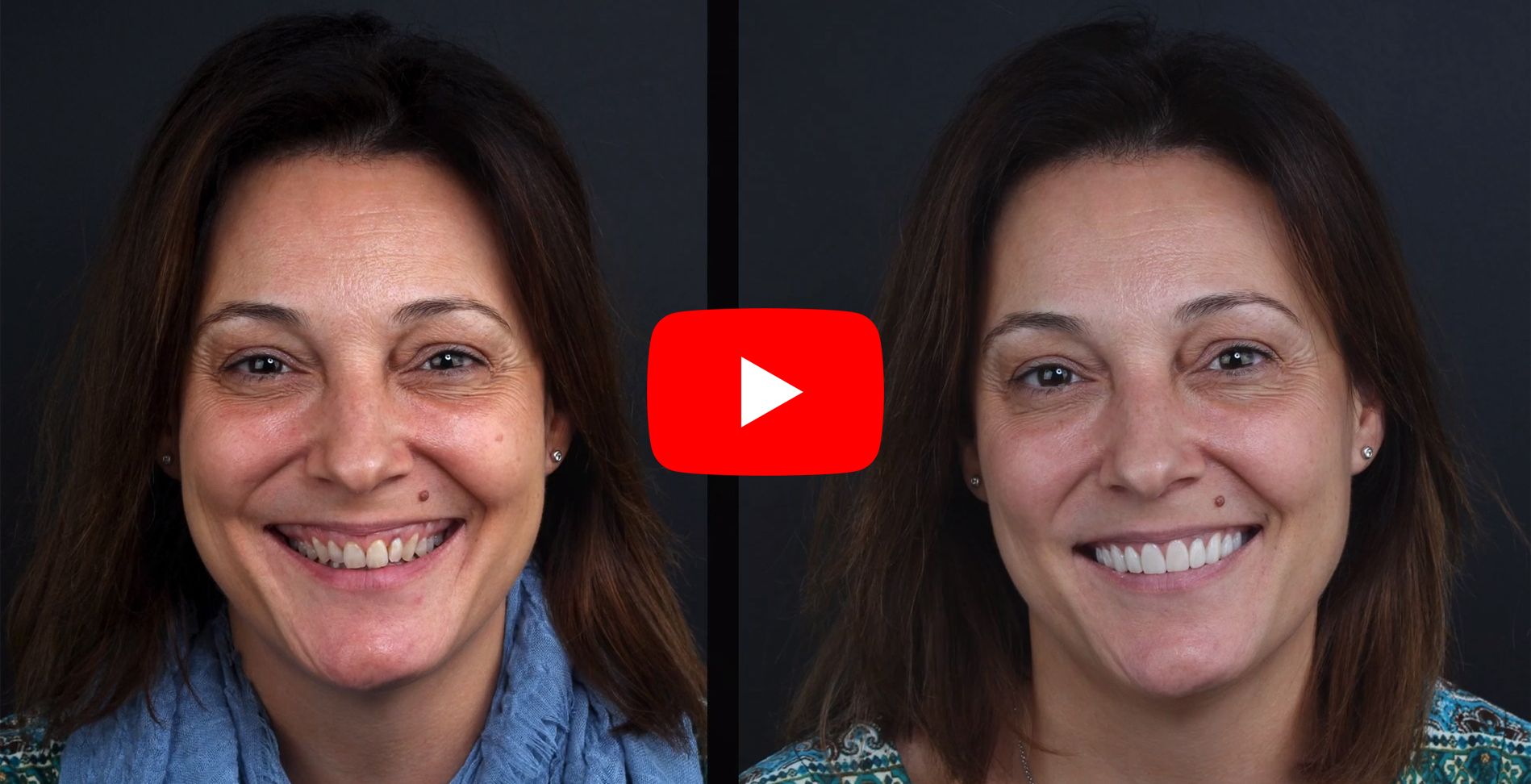 Video testimonials of patients treated at the Padrós dental clinic veneer