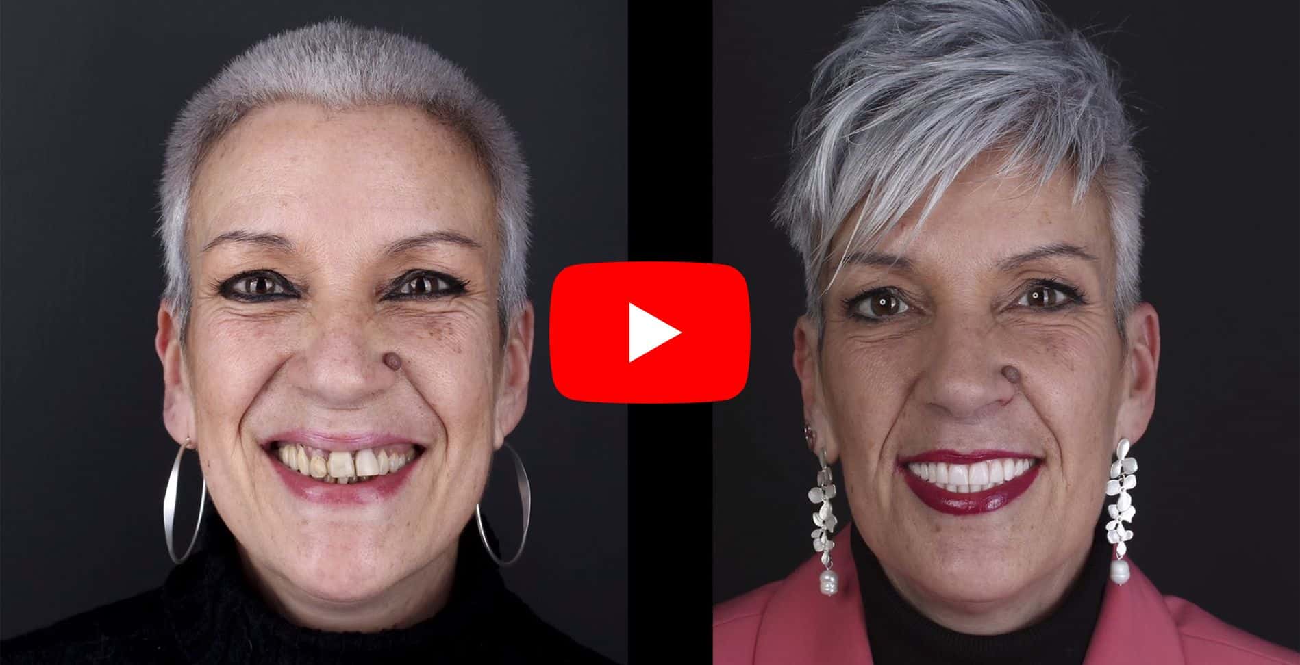 Video testimonials of patients treated at the Padrós dental implant clinic