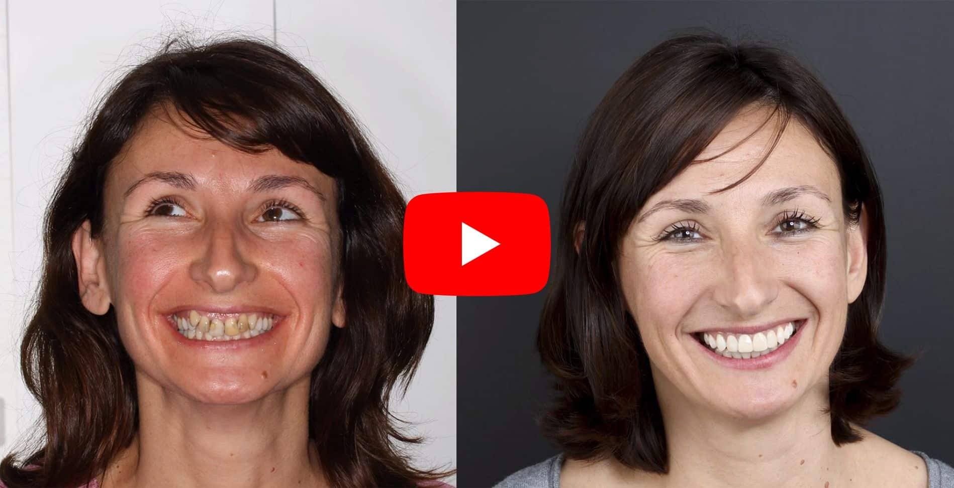 Video testimonials of patients treated at the Padrós dental clinic orthodontics