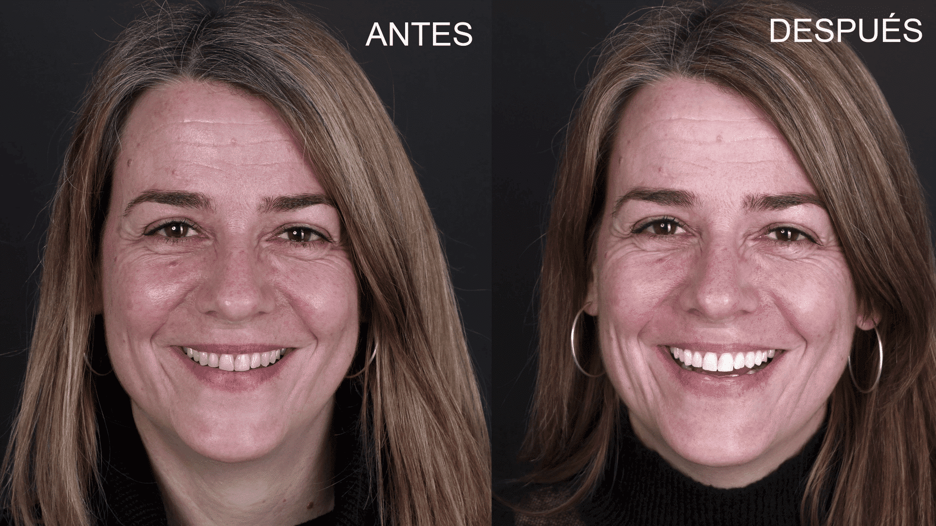 Dental case of teeth whitening treatment performed at the Padrós dental clinic in Barcelona