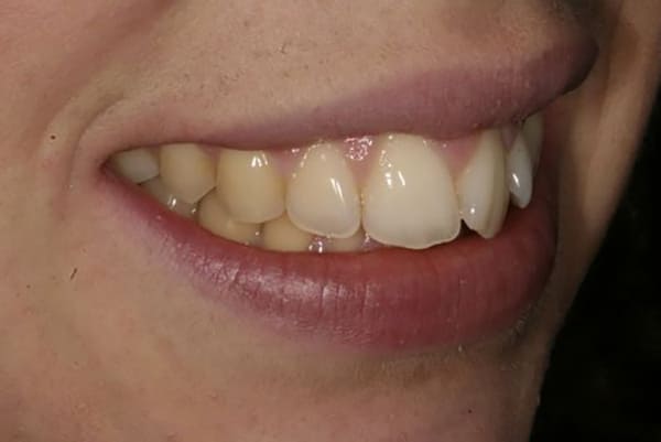 Analizando muestras de casos prácticos del tratamiento de ortodoncia rápida en Barcelona Inman Aligner. En la imagen se observa la posición de los dientes en uno de los pacientes tratados en nuestra clínica dental antes de haberse sometido al tratamiento.